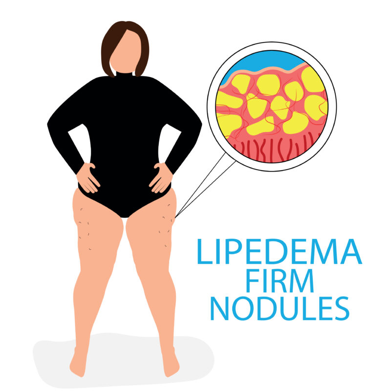 Lipedema fat vs normal fat