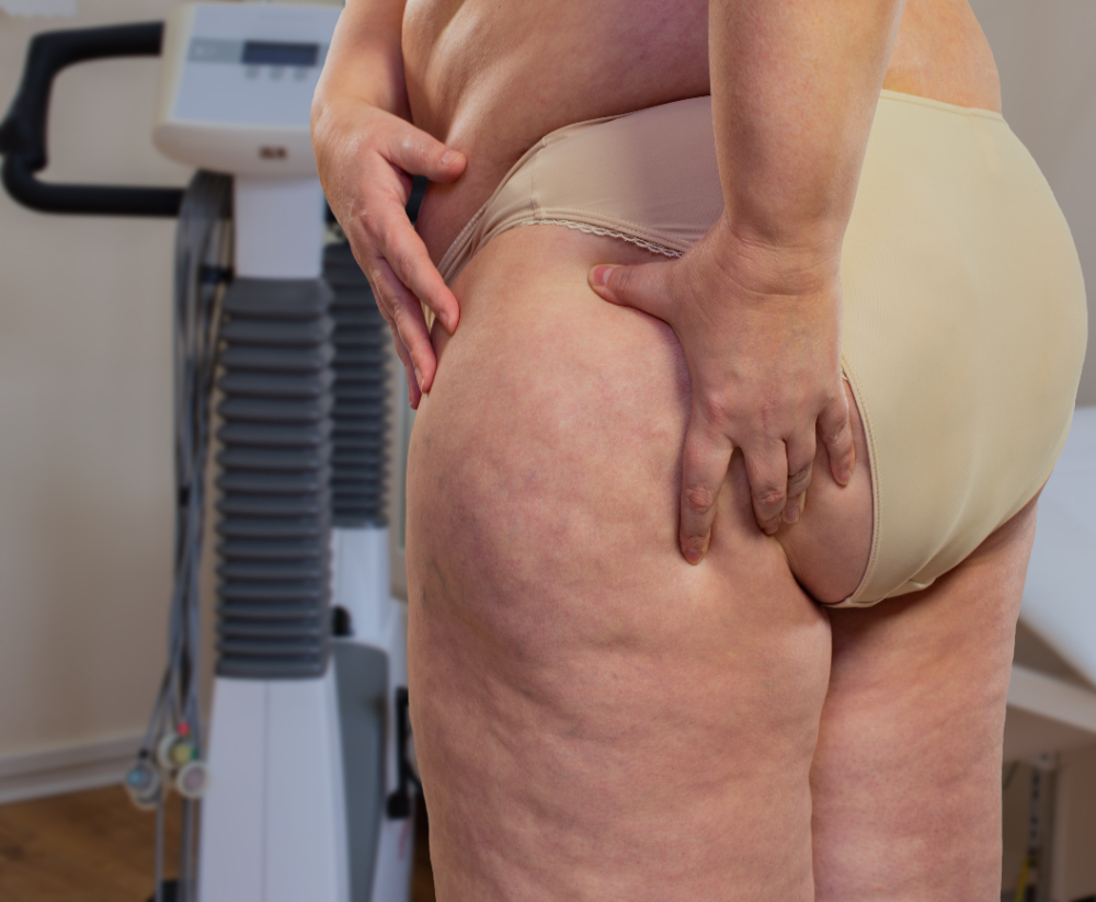 Understanding and Managing Lipedema as a Chronic Condition