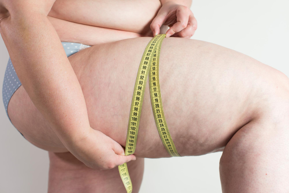 Understanding Lipedema: Causes, Symptoms, and Treatment Options