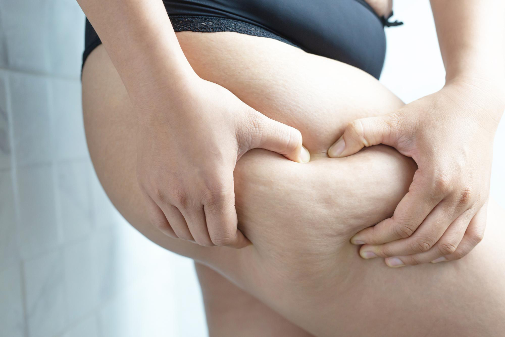 Recognizing the Signs of Lipedema and Exploring Treatment Options