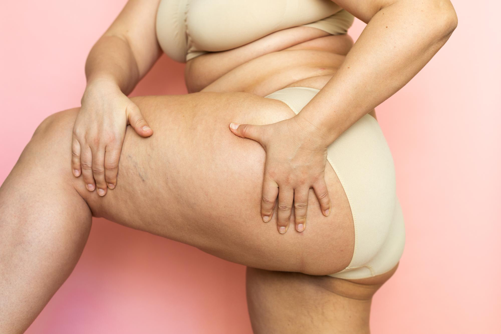 Understanding the Link Between Lipedema and Cellulitis