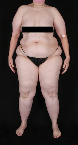 Patient's body before Lipedema Surgery