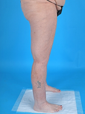 Patient's body after Lipedema Surgery