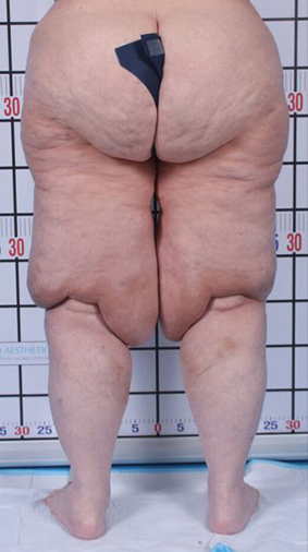 Patient's legs after Lipedema Surgery