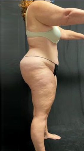 Patient's body before Lipedema Surgery