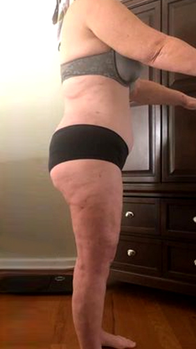 Patient's body after Lipedema Surgery