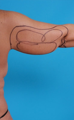 Patient's arm before Lipedema Surgery