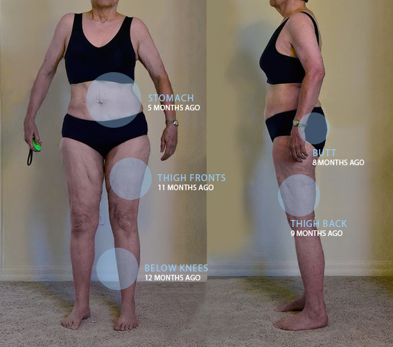 Patient's body after Lipedema Surgery