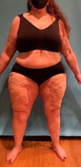 Patient's body after Lipedema Surgeryy