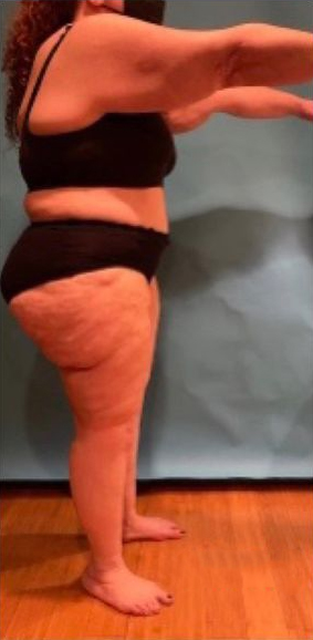 Patient's body after Lipedema Surgery