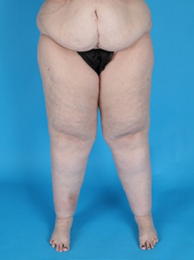 Patient's body before Lipedema Surgery