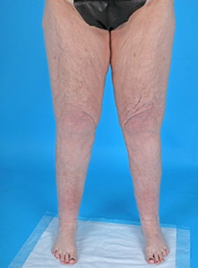 Patient's body after Lipedema Surgery