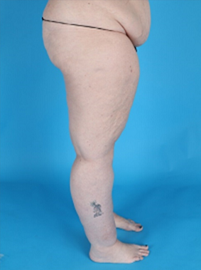 Patient's body before Lipedema Surgery