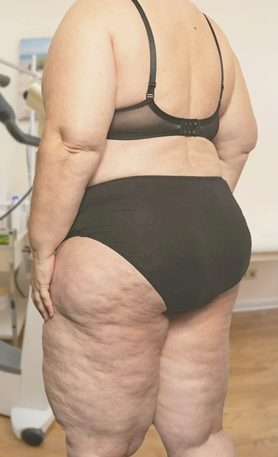 Back view of woman's body with Lipedema