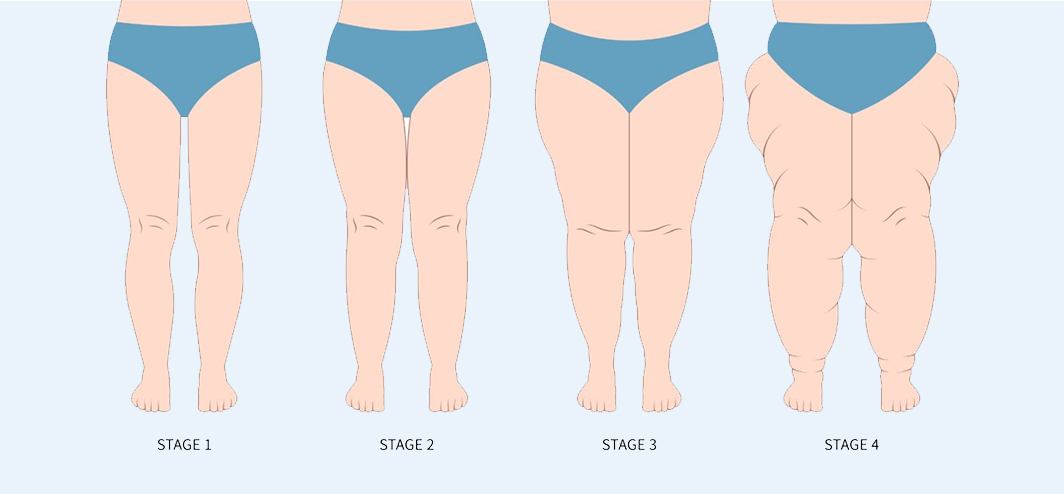 Stages of Lipedema - Visual representation