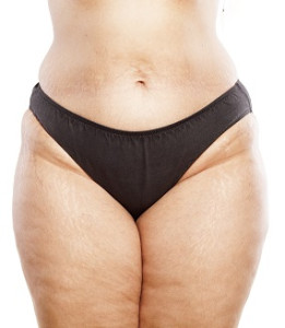 Lipedema Legs | Liposuction | Atlanta GA