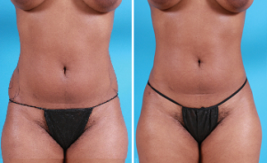 Abdomen Liposuction | Atlanta | Patient 2 | Before and After Photos | Front View | Dr. Marcia Byrd