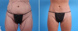 Liposuction | Atlanta | Patient 1 | Before and After Photos | Front View |Dr. Marcia Byrd