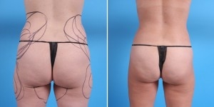 Liposuction | Atlanta | Before and After Photos | Dr. Marcia Byrd