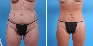 Abdomen Liposuction | Atlanta | Before and After Photos | Dr. Marcia Byrd
