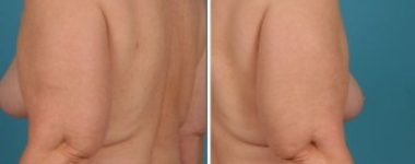 Arm Lift | Atlanta | Before and After Photos | Dr. Marcia Byrd