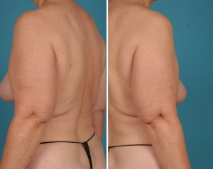 Arm Lift | Atlanta | Before and After Photos | Dr. Marcia Byrd