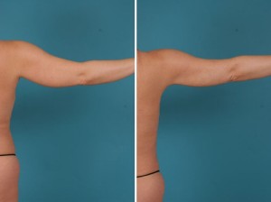 Arm Lift | Atlanta | Before and After Photos | Dr. Marcia Byrd