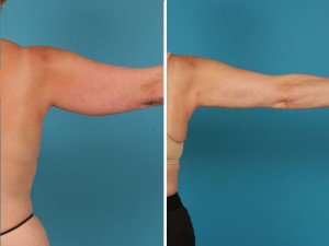 Arm Lift | Atlanta | Before and After Photos | Dr. Marcia Byrd