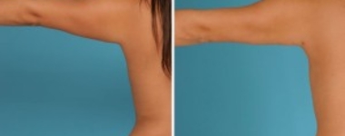 Arm Lift | Atlanta | Before and After Photos | Dr. Marcia Byrd