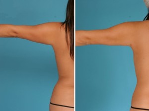 Arm Lift | Atlanta | Before and After Photos | Dr. Marcia Byrd