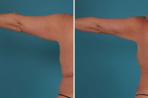Arm Lift | Atlanta| Before and After Photos | Dr. Marcia Byrd
