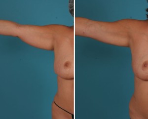 Arm Lift | Atlanta | Before and After Photos | Dr. Marcia Byrd