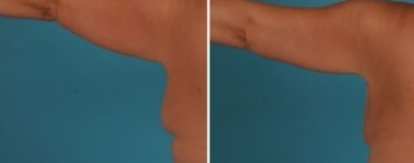 Arm Lift | Atlanta | Before and After Photos | Dr. Marcia Byrd