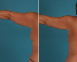 Arm Lift | Atlanta | Before and After Photos | Dr. Marcia Byrd