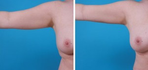 Arm Lift | Atlanta | Before and After Photos | Dr. Marcia Byrd