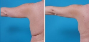 Arm Lift | Atlanta | Before and After Photos | Dr. Marcia Byrd