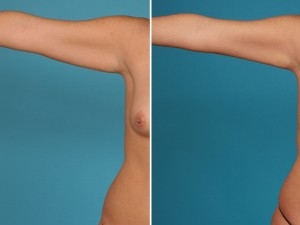 Arm Lift | Atlanta | Before and After Photos | Dr. Marcia Byrd