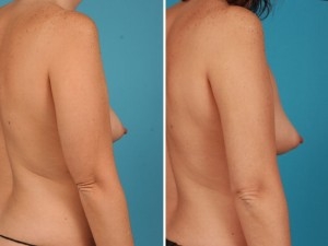 Arm Lift | Atlanta | Before and After Photos | Dr. Marcia Byrd