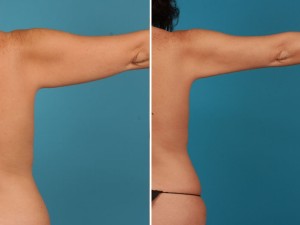 Arm Lift | Atlanta | Before and After Photos | Dr. Marcia Byrd