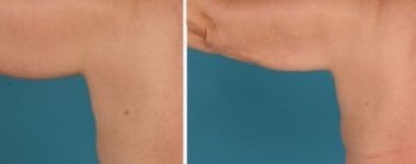 Arm Lift | Atlanta | Before and After Photos | Dr. Marcia Byrd