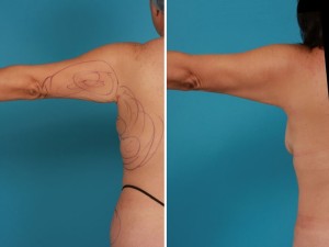 Arm Lift | Atlanta | Before and After Photos | Dr. Marcia Byrd