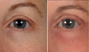 Blepharoplasty | Atlanta | Before and After Photos | Dr. Marcia Byrd