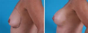 Breast Augmentation | Atlanta | Before and After Photos | Dr. Marcia Byrd