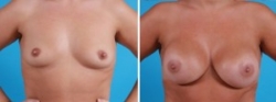 Breast Augmentation | Atlanta | Before and After Photos | Dr. Marcia Byrd