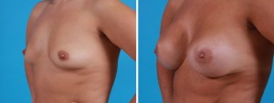 Breast Augmentation | Atlanta | Before and After Photos | Dr. Marcia Byrd