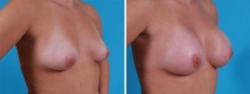 Breast Augmentation | Atlanta | Before and After Photos | Dr. Marcia Byrd