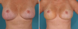 Breast Reduction | Atlanta | Before and After Photos | Dr. Marcia Byrd