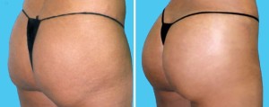 Brazilian Butt Lift | Atlanta | Patient 10 | Before and After Photos | Oblique View | Dr. Marcia Byrd