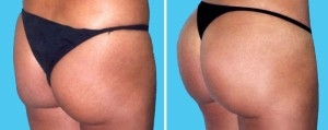 Brazilian Butt Lift | Atlanta | Before and After Photos | Dr. Marcia Byrd