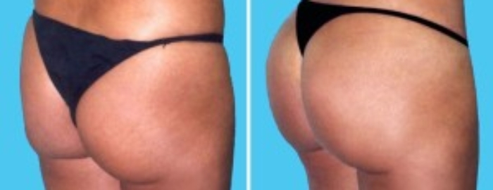 Brazilian Butt Lift | Atlanta | Before and After Photos | Dr. Marcia Byrd